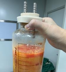 慈溪水动力吸脂手术要做多久？